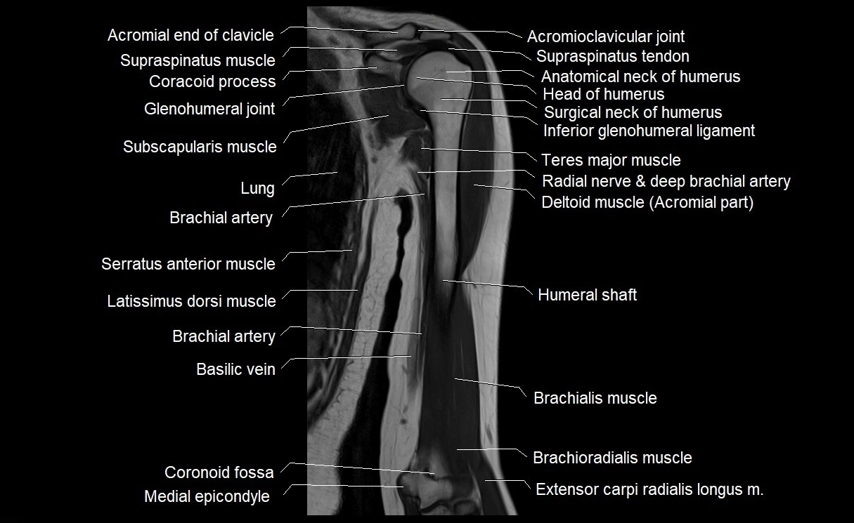 MRI upper arm (humerus ) coronal cross sectional anatomy image 13.webp